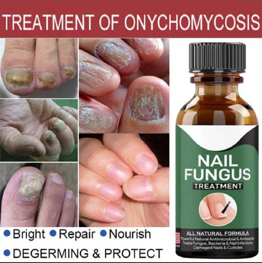 Foot Cure Nail Fungus Treatment – Natural Antifungal Oil for Damaged Nails - Trendy Crate Pk