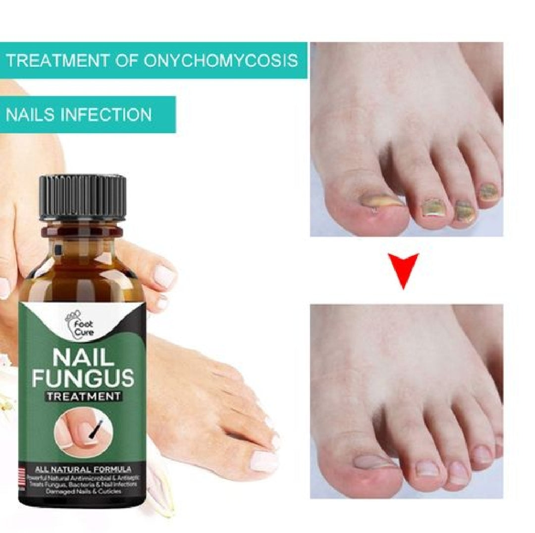 Foot Cure Nail Fungus Treatment – Natural Antifungal Oil for Damaged Nails - Trendy Crate Pk