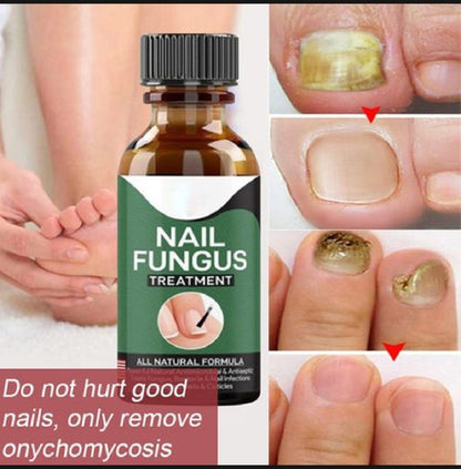 Foot Cure Nail Fungus Treatment – Natural Antifungal Oil for Damaged Nails - Trendy Crate Pk