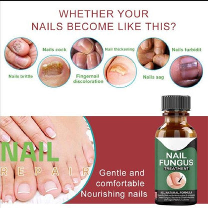 Foot Cure Nail Fungus Treatment – Natural Antifungal Oil for Damaged Nails - Trendy Crate Pk