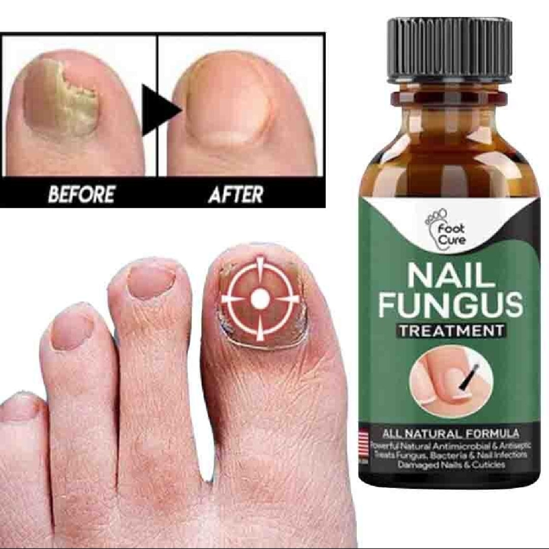 Foot Cure Nail Fungus Treatment – Natural Antifungal Oil for Damaged Nails - Trendy Crate Pk